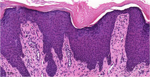 Histopathology of chronic prurigo showing hyperkeratosis with sparse parakeratosis, irregular acanthosis, discrete spongiosis, vascular prominence in the dermal papillae, fibroplasia of the superficial dermis and lymphocytic inflammatory infiltrate, mostly perivascular (Hematoxylin & eosin, ×400).