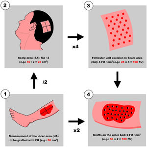 Quick view for the calculation of follicular units (FU) per ulcer area to be treated (UA, Ulcer Area; SC, Scalp Area).
