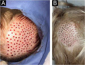 (A) Circular defects after extraction of follicular units. (B) Evolution of donor area healing at 72 hrs.