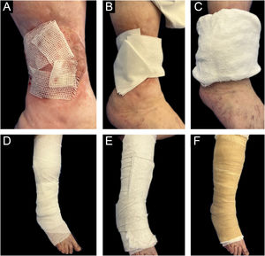 Sequence of Coverage and adapted multi-layer bandage. (A) Petrolatum-infused gauze, (B) Dry gauze, (C) Dressing, (D) Gauze bandage, (E) Ovate bandage, (F) Elastic wrap.