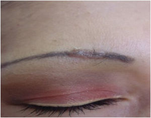 Papulonodular lesions following cosmetic eyebrow tattooing. The final diagnosis was sarcoidosis. Photographic archive of the Dermatology Service at the University of Antioquia.