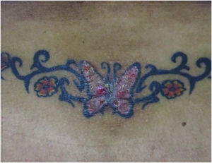Papulonodular lesions over a black and red tattoo in the lower lumbar region. The histopathological diagnosis was pseudolymphoma. Photographic archive of the Dermatology Service at the University of Antioquia.