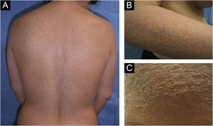 (A, B and C) scaly plaques with cracks and erythematous edges (ichthyosis).