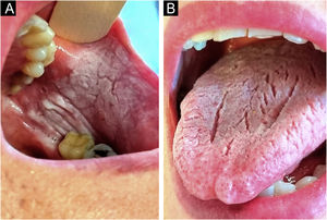 (A) Whitish lesions on the buccal mucosa. (B) Plaque with a whitish, velvety surface on the dorsal tongue.