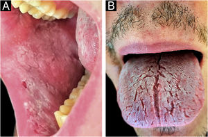 (A) Her son with a well-demarcated white patch present on the buccal mucosa. (B) Plaque with a whitish and a spongy appearance on the dorsal tongue.