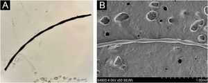 Microscopy and scanning electron microscopy of the proband. (A) Light microscopic showed characteristic elliptical nodes and intermittent constriction. (B) Scanning electron microscopy revealed that cylindrical hair had a segmental structure with periodic nodules and narrow parts.