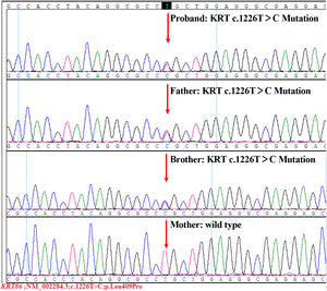 The sequence of the heterozygous mutation in KRT86. The proband, her father and her brother all had a heterozygous T to C mutation (c.1226T＞C, p.Leu409Pro) in the exon 7 of KRT86. The sequence of mother was normal.