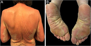 Orange-red squamous plaques with islands of sparing in the trunk and both arms (A). Orange-red waxy and symmetrical palmoplantar keratoderma (B).