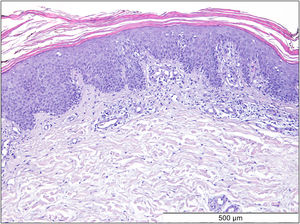 Histological examination revealed moderate acanthosis with hyperkeratosis and parakeratosis: mild epidermal spongiosis and, in the superficial dermis, a mild perivascular chronic inflammatory cell infiltrate (Hematoxylin & eosin).