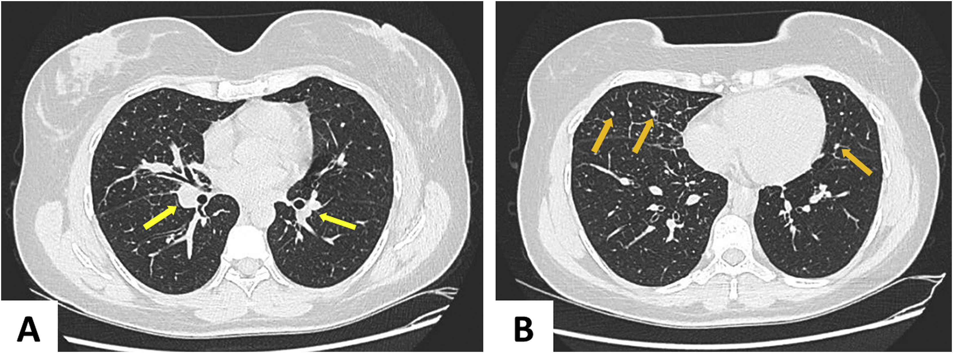 Löfgren's syndrome manifestation of acute sarcoidosis: short-term ...