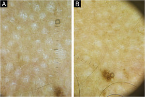 Dermoscopy with polarized light of a patient with chronic pityriasis versicolor. (A) Circular macules centered on the hair follicles, with the presence of desquamation after the Zirelí propaedeutic maneuver, compatible with active disease. (B) After eight weeks of treatment with oral isotretinoin, a reduction in the number and size of lesions was observed, with no desquamation after the Zirelí maneuver, compatible with post-inflammatory hypochromia after resolution (Dermatoscope DL5 Dermlite®, ×10).