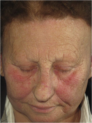 Erythema and telangiectasias on the malar, zygomatic and peri-palpebral regions in a patient with FFA.