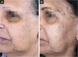 Facial papules in a patient with FFA before treatment with oral isotretinoin in the image on the left and after treatment in the image on the right.