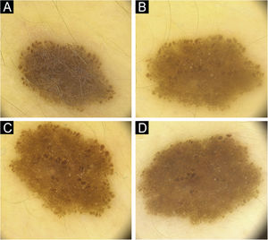 (A) Pediatric melanocytic nevus with a diameter of 3.5 mm homogenous-globular pattern in the center and peripheral globules arranged regularly in a single row. (B) There is an increase in nevus diameter to 4.3 mm in 12 months with similar number of peripheral globules. (C) Increase in nevus diameter continues, with a decrease in peripheral globules. (D) Noticeable enhancement in the central homogenous structure and a significant decrease in peripheral globules, nevus starts to stabilize with a diameter of 4.6 mm at 36th months.