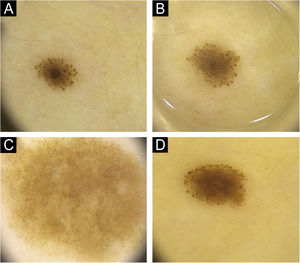 (A) Pediatric nevus with a diameter of 2.3 mm with darker globular-homogenous pattern and the globules are prominent at the periphery. (B) In the follow up of the same nevus, diameter increases to 3.5 mm in 12 months, homogenization in the central region and a lightening of color to light brown are observed. (C) In a different nevus, a globular structure is vaguely discernible around and the nevus has taken an almost homogenous structure with stabilization. (D) Nevus with a raised dermal component in the center and a continuation of the globular structure at the periphery.