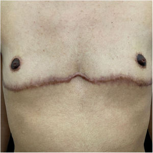 A trans man presented with keloid scars following bilateral mastectomy.