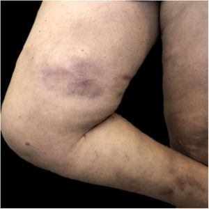 A trans woman with a history of silicone injections in the buttocks a decade ago presented with siliconomas on the inner side of her right thigh.