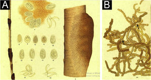 Drawings from the original 1911 publication. (A) Dark nodules on the hair shaft and the formation of ascospores (8 to 18). (B) Microscopic appearance of the etiological agent with hyphae, which show round dilations (arrows).