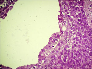 Apocrine poroma: Glandular lumen lined by apocrine epithelium with decapitation secretion. (Hematoxylin & eosin, X400).