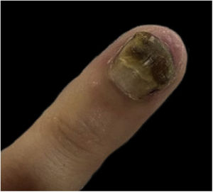 Proximal leukonychia, distal yellow-brown chromonychia, and onychomadesis on the fourth left finger.