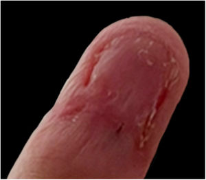 Postoperative result. A scar on the nail bed is observed.