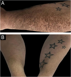 (A) Polygon-shaped brown, grey, or white scales on the forearm. (B) Healed lesions.