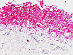 Orthohyperkeratosis, absence of granular cell layer and mild acanthosis are observed in the epidermis. In the upper dermis is a mild perivascular lymphocytic infiltrate (Hematoxylin & eosin, ×200).