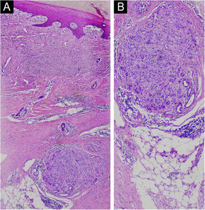 In the deep dermis, a circunscribed area of atypical morphology suggesting melanoma (likely residual or recurrent) (Hematoxylin & eosin, ×40 on the left and ×100 on the right).