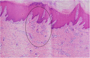 Grouped proliferated dilated capillary vessels close to the eccrine ducts, in the area circled in black (Hematoxylin & eosin ×40).