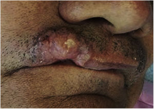 Tumor lesion with a 10-year evolution.