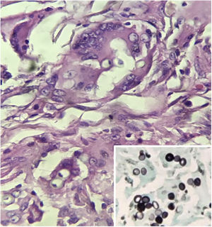 Histopathology of the surgical specimen. Presence of fungal elements, of similar size, with thick and birefringent walls inside giant cells (Hematoxylin & eosin, ×400). Microphotography: Rounded, birefringent fungal structures in a catenulate arrangement. (Grocott, ×600).