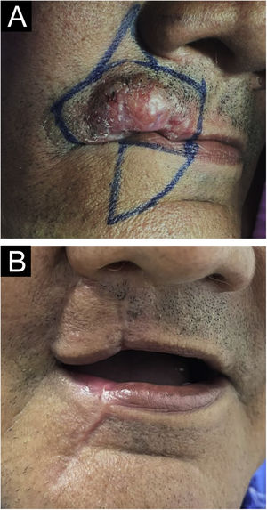 (A) Surgical markings before resection. (B) Five months after the procedure.