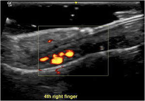 Increased vascularization in the nail matrix ‒ longitudinal axis.