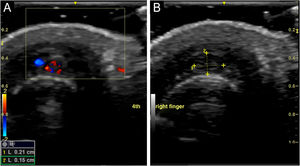 (A) Hypoechoic vascular lesion in the nail matrix – transversal axis. (B) Lesion measuring 2.1 × 1.5 mm ‒ transversal axis.