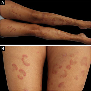 Annular and arcuate erythematous plaques with a dusky pigmentated center on the lower limbs (A). Detailed view of the lesions on the thighs (B).