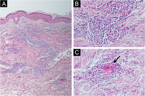 (A e B) Deep and superficial perivascular lymphocytic infiltrates with numerous eosinophils and flame figures (arrow) (C). Hematoxylin & eosin ×100 (A), ×200 (B‒C).