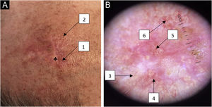 (A) Macroscopy of a pearly-yellow plaque with unclear borders on an erythematous base (*) with telangiectasias on the periphery (1) and yellowish papules (2) on the upper region. (B) Dermoscopy (×10 magnification) showing round whitish-yellow structures in a cobblestone pattern (3), telangiectasias (4), arboriform vessels (5) and rounded whitish-yellow papules with central umbilication and crown vessels (6).