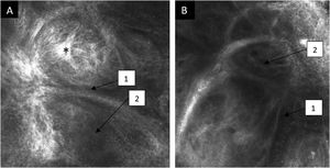 Confocal reflectance microscopy of the papillary dermis showing basal cell carcinoma with individual images measuring 0.5×0.5 mm2 and a mosaic measuring 8×8 mm2. (A and B) Tumor island (*) with peritumoral clefting (1) and dark silhouettes (2).