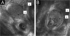 Confocal reflectance microscopy of the papillary dermis of the nevus sebaceous with individual images measuring 0.5×0.5 mm2 and mosaics measuring 8×8 mm2. (A and B) Central tube-shaped structures (*), with sebaceous gland lobes in the surrounding area (1), filled with aggregates similar to fish ova (2).