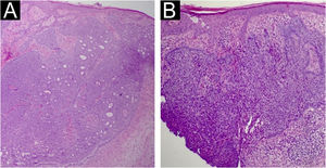 Histopathology. (A) Nodular basal cell carcinoma with an adenoid pattern, in association with a nevus sebaceous. (B) Superficial and nodular basal cell carcinoma in association with a nevus sebaceous (Hematoxylin & eosin, A ×100 and B ×200).