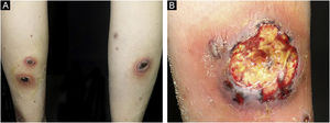 (A) Multiple ulcers with erythematous raised borders on the posterior aspects of both lower extremities. (B) The largest ulcer had a diameter of 6 cm adjacent to the right ankle.