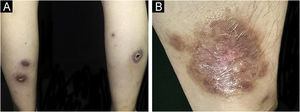 (A-B) The ulcers almost resolved after eight weeks of treatment.