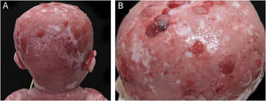 A child with Hay-Wells syndrome at one year old. Foci of exuberant granulation tissue and bacterial colonization seen in the parietal-occipital region of the scalp (A) and the parietal region (B).