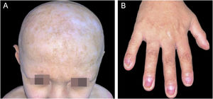 Child at nine years old, showing (A) cicatricial alopecia and (B) onychodystrophy in all fingers besides hyponychia in the 1st and 5th fingers.