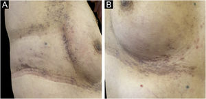 Bilateral submammary reticular gray hyperpigmented lesions with papules and desquamation (A, B).