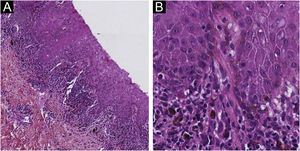 Histopathological findings. Lymphohistiocytic infiltrate with dermal melanin incontinence, lichenoid band-like of the papillary dermis with intraepidermal pagetoid migration and acanthotic epidermal layer. Hematoxylin & eosin ×100 (A) and ×400 (B).