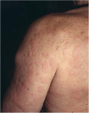 Urticarial lesions on the trunk and left arm.