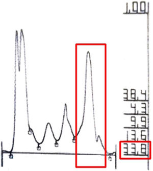 Increased IgM levels in serum protein electrophoresis test.