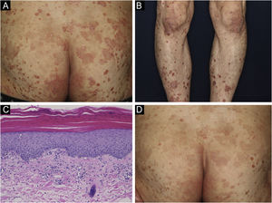 (A) Psoriasiform lesions on the buttocks. (B) Similar lesions on the lower legs. (C) Histological findings revealed slight parakeratosis with a slightly flattened epidermis. Inflammatory cell infiltration was observed around blood vessels and stroma in the superficial dermis, accompanied by red blood cell extravasation. The inflammatory cells were eosinophils as well as lymphocytes and histiocytes. (Hematoxylin & eosin, ×200). (D) After treatment, the skin rash was partially improved.