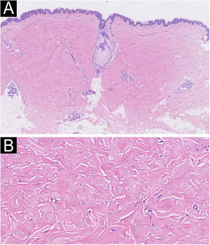 Histopathology revealed a proliferation of myofibroblasts and thickened sclerotic collagen bundles in the dermis (A, Hematoxylin & eosin ×20; B, Hematoxylin & eosin ×200).